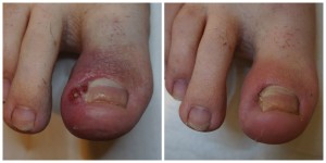 leczenie stanu zapalnego wrastających paznokci gorzów